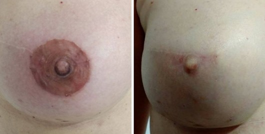 Reconstrução da mama pelo tatuador Kiko Tatto (Divulgação)